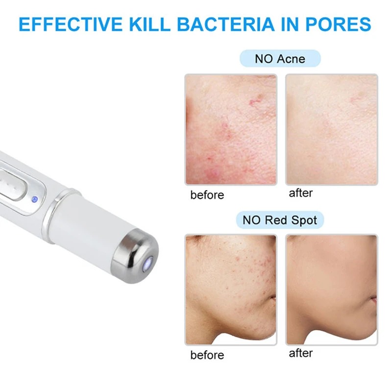 laser pen for skin care فوائد قلم الليزر لتقليل الحبوب والدوالي وتحسين مظهر البشرة في السعودية